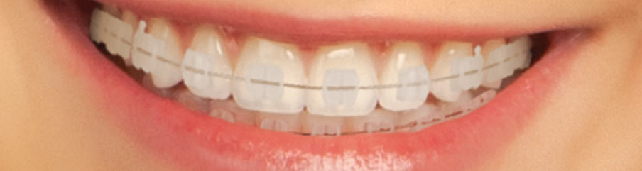 3M Clarity Clear Braces