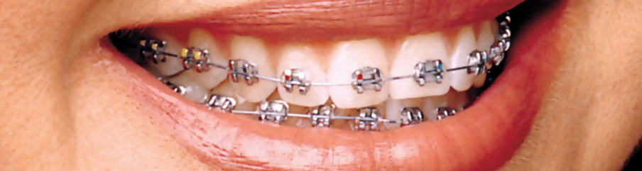 3M Victory Series Braces